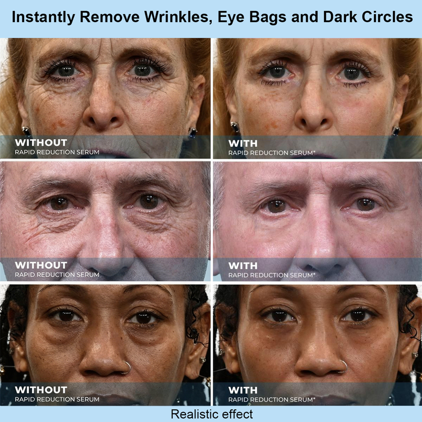 Renuvae™ Instant Face Temporary Tightener – Instant visible results in 60 seconds